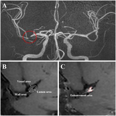 Effect of PCSK9 inhibition in combination with statin therapy on intracranial atherosclerotic stenosis: A high-resolution MRI study